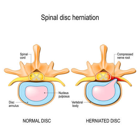 Spinal disc herniation. Back pain. Normal disc and spinal disc herniation in cervical vertebrae. Vector illustration for your design, educational, biology, scientific, and medical use.のイラスト素材