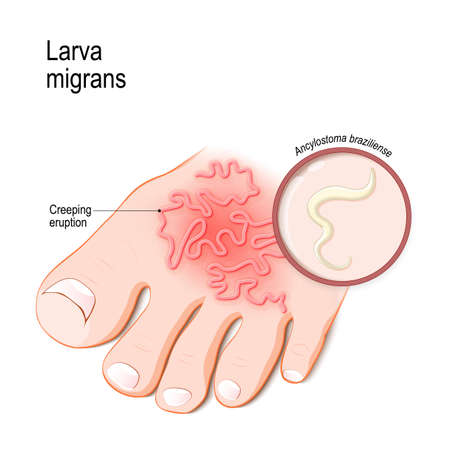 Cutaneous larva migrans. Skin disease in humans caused byhookworm (Ancylostoma braziliense). Vector illustration for medical, biological, science and educational useのイラスト素材