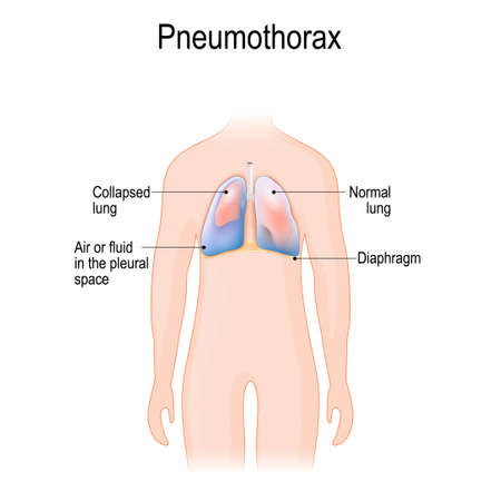 Collapsed lung. abnormal collection of air (pneumothorax) or fluid (pleural effusion) or pus (empyema) in the pleural space between the lung and the chest wall.のイラスト素材