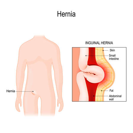 Inguinal Hernia. bowel exit through the wall of the abdomen cavity. Vector diagram for educational, medical, biological, and scientific useのイラスト素材
