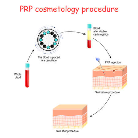 PRP cosmetology procedure. test tubes and syringe with blood and platelet-rich plasma. Vector diagram for educational, medical, biological and science useのイラスト素材