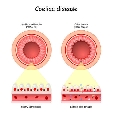 Celiac or Coeliac disease. leaky gut. Cross section of Healthy small intestine with normal villi, and Epithelial cells damagedのイラスト素材