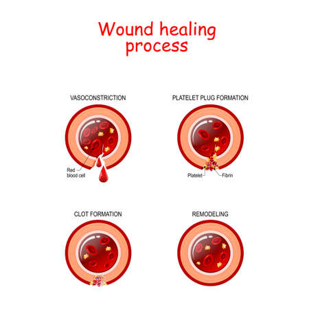 Phases of the wound healing process. Hemostasis, Inflammatory, Proliferative, Maturation and remodeling phase. Cross section of blood vessel.のイラスト素材