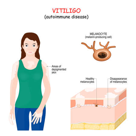 Vitiligo. autoimmune disease. Female with Areas of depigmented skin. Close-up of a Melanocyte. Cross section of the human skin with pigment cells (healthy and Disappearanced). Vector illustration for medical use.のイラスト素材