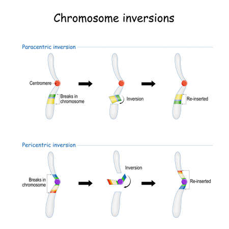 Chromosomal inversion occurs when a single chromosome undergoes breakage and rearrangement within itself.のイラスト素材