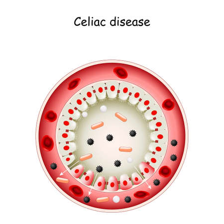 Celiac disease. Cross section of Small intestine lining damage. good and damaged villi. leaky gut. Coeliac (sprue) disease: an autoimmune disorder against gluten (gliadin). cells on gut lining held tightly together. Vector diagramのイラスト素材