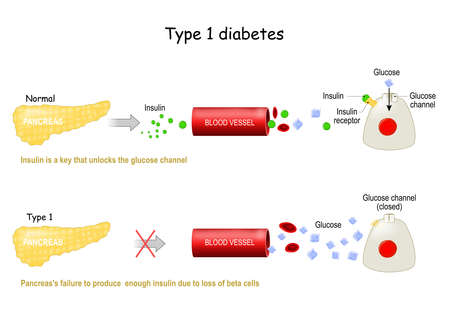 Types 1 of Diabetes Mellitus. Pancreas's failure to produce  enough insulin due to loss of beta cells. Insulin is a key that unlocks the glucose channel. The absorption of glucose by the cell. Infographic. Vector illustrationのイラスト素材