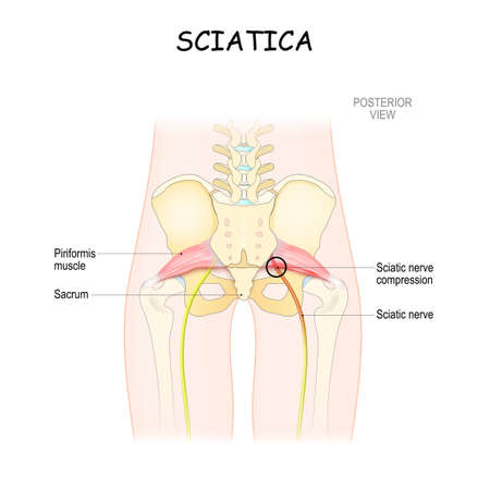 piriformis syndrome. medical vector illustration. sciatica and causes. patient body from back. posterior viewのイラスト素材