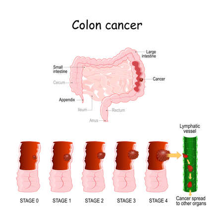 colon cancer. Colorectal oncology. Development of a malignant tumor from 0 to 4 Stages. medical diagram. vector illustration. digestive system.のイラスト素材