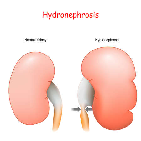 Hydronephrosis. Normal human's kidney and kidney affected by Hydronephrosis. exterior view of a healthy and diseased kidneys.のイラスト素材