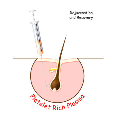 Platelet rich plasma for Rejuvenation and Recovery skin and hair. PRP treatment for hair. Icon with syringe and a hair follicle. Vector illustrationのイラスト素材