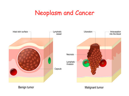 Cancer and Neoplasm. comparison and difference between Malignant and Benign tumor. Benign tumor has a Capsule. Cells of Malignant tumor have Necrosis, Intravasation into the blood vessel, and Lymphatic Invasion.のイラスト素材