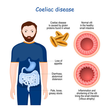 Celiac disease is a autoimmune disorder that affects the small intestine. Signs and symptoms of celiac disease. Cross section of small bowel with normal and shortening of the villi (villous atrophy). Vector illustrationのイラスト素材