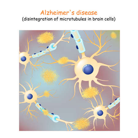 Alzheimer's disease. dementia. Vector Background with neurons and amyloid plaques (tau protein that...