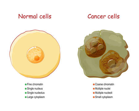 Cancer and normal cells. comparison and difference between healthy tissue and tumor. details about chromatin, nucleus and cytoplasm. Vector illustrationのイラスト素材