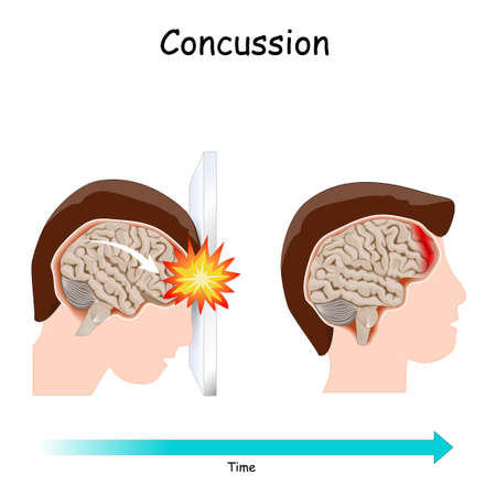 Concussion. Human's head. brain after head trauma. Vector illustrationのイラスト素材