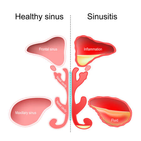 Sinusitis. Healthy nasal sinus and sinus with infection (inflammation and fluid). vector illustrationのイラスト素材