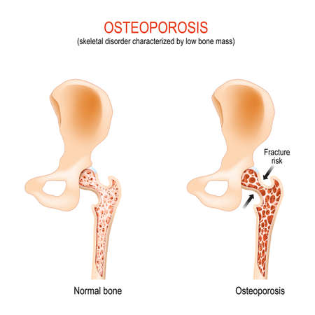 Osteoporosis. normal hip joint and bone with skeletal disorder that is characterized by low bone mass. femur Fracture risk. difference and comparisonのイラスト素材