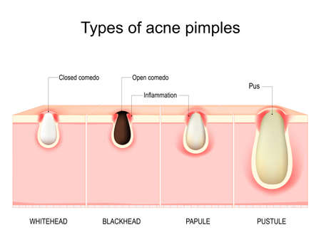 Types of acne pimples. Cross section of human Skin with acne vulgaris. Whitehead, Blackhead, Papule, and Pustule. vector diagram.のイラスト素材
