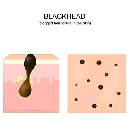 Acne. blackhead. clogged pore. Cross-section of a human skin with Hair follicle. Top view of the skin with pimples. Vector illustration. posterのイラスト素材