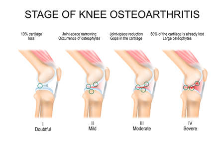 knee Osteoarthritis. Stages of OA. Kellgren and Lawrence criteria for assessment stage of osteoarthritis. The classifications are based on osteophyte formation and joint space narrowing. side view. Vectorのイラスト素材