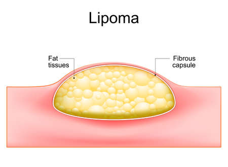 Lipoma. adipose tumors located into the subcutaneous tissues in the skin. Cross section of a human skin. vector illustration.のイラスト素材