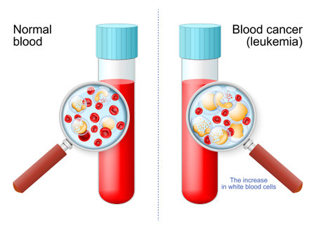 Leukemia. Red and white blood cell in Test tube in magnifying glass. comparison and difference between healthy blood and blood cancer. Close-up of erythrocytes, monocyte, basophil, eosinophil, neutrophil, lymphocyteのイラスト素材