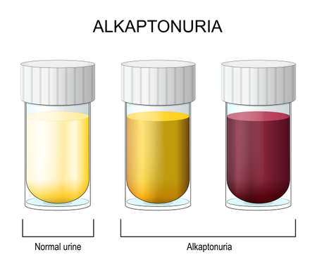 Alkaptonuria. Color change in Urine from Normal to alkaptonuria. Laboratory flasks with urine. comparison. homogentisic acid can turn urine and parts of the body a dark colour. Vectorのイラスト素材