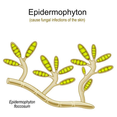 Epidermophyton floccosum. fungal infections of the skin. vector illustrationのイラスト素材