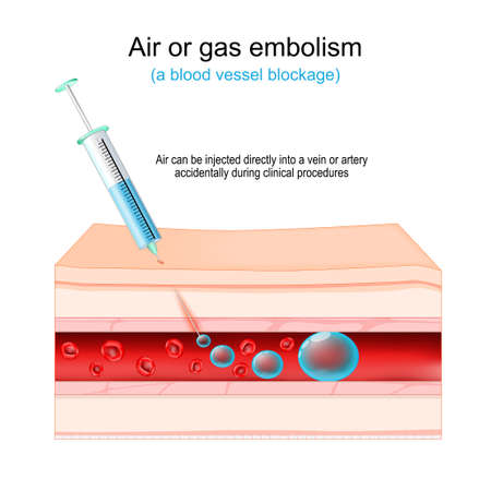 Air or gas embolism. blood vessel blockage. Air that is injected directly into a vein or artery accidentally during clinical procedures. Human skin, syringe, blood vessel with red blood cells and air bubbles. vector illustrationのイラスト素材
