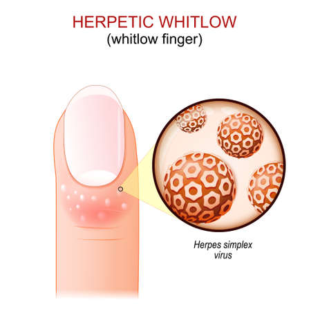 herpetic whitlow. whitlow fingers. Human's finger with skin disease. Close-up of virions of Herpes simplex virus. vector illustrationのイラスト素材