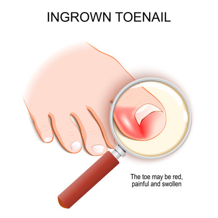 Ingrown toenail. Top view of a magnifying glass and Foot with nail that grows into the toe. sore toe is red, painful and swollen. disease. medical infographic. vector illustration.のイラスト素材