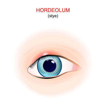 style. Close-up of human's eye with hordeolum on the upper eyelid. vector illustrationのイラスト素材