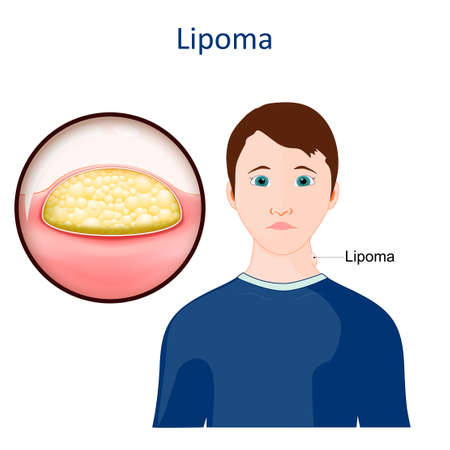 Lipoma. skin disease. Close-up of a growth of fat tissue under human skin. vector illustrationのイラスト素材