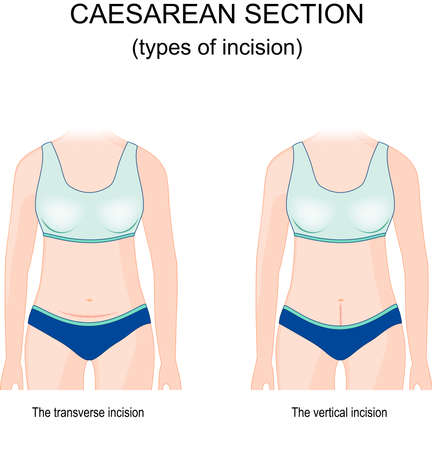 caesarean section. types of incision. horizontal and vertical suture. The vertical incision and low transverse abdominal incision after C-section has been completed. front view of a female belly after abdominal surgery.のイラスト素材