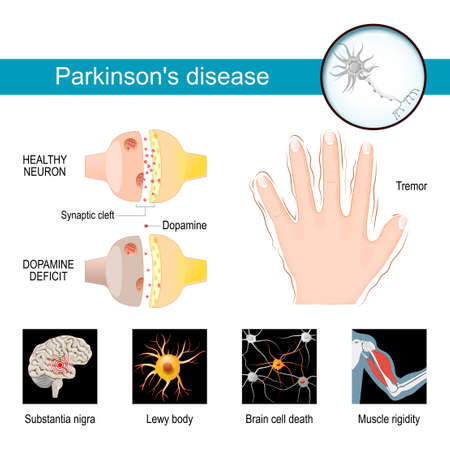 Parkinson's disease Infographic. Healthy neuron, and Synaptic cleft with dopamine deficit. Symptoms of a parkinsonism. Tremor or hands shaking. Muscle rigidity, Brain cell death, Lewy body and Substantia nigra. Vector poster and medical materials for your designのイラスト素材