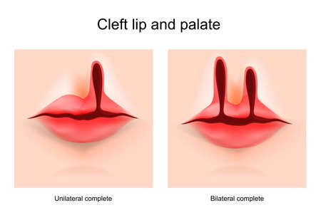 Cleft lip and cleft palate. face of a child with a defect cleft. hare-lip. Unilateral and bilateral complete. vector posterのイラスト素材