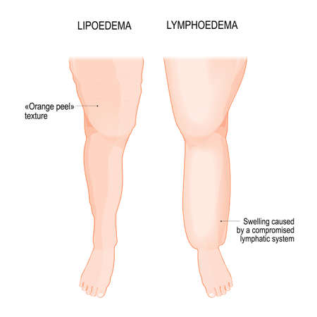 Lymphedema and Lipoedema. Comparison and difference of Lipedema leg, and leg with lymphatic insufficiency. overweight problem. Lipoedema is a abnormal build-up of fat in legs, orange peel skin. Lymphedema - disorder in the lymphatic system. vector poster