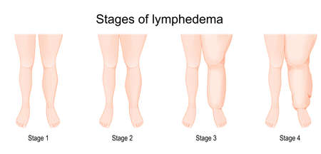 Severity of lower extremity lymphedema at different stages. vector illustrationのイラスト素材