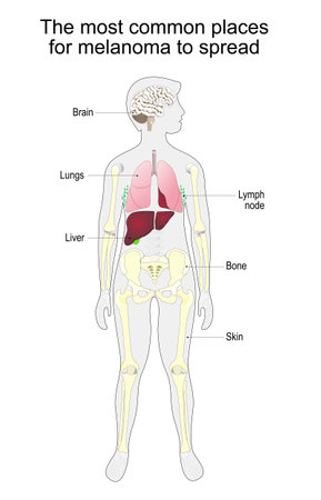 metastasis of skin cancer. malignant melanoma. The most common places for melanoma to spread. vector diagramのイラスト素材