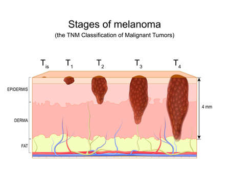 stages of melanoma. The TNM Classification of Malignant Tumors. metastasis of skin cancer. malignant melanoma. vector diagram