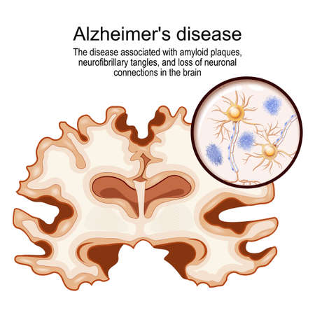 Alzheimer's disease. disease associated with amyloid plaques, neurofibrillary tangles, and loss of neuronal connections in the brain. human brain with Alzheimer's disease. Close-up of neurons with amyloid plaques. vector illustrationのイラスト素材