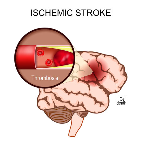 ischemic stroke. human brain. Close-up of a blood clot in an artery resulting in brain death to the affected area. thrombosis. Cerebral infarction. Brain ischemia. vector poster