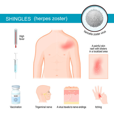 Shingles. infographics about Signs and symptoms of herpes zoster. Human torso with itching rash. Close up of Varicella zoster virus. The virus travels to nerve endings in the skin, producing blisters. Trigeminal nerve is the most commonly involved nerve. vector illustration.のイラスト素材