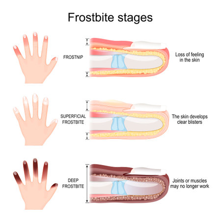 Frostbite stages of fingers. From Frostnip with Loss of feeling in the skin to Deep Frostbite of Joints and muscles. vector illustrationのイラスト素材