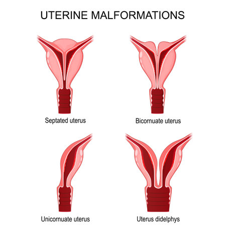 uterine malformations. Unicornuate, didelphys, Bicornuate, and Septated uterus. vector poster for medical useのイラスト素材