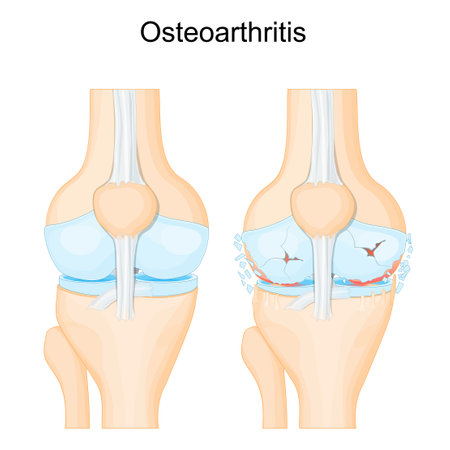 Knee osteoarthritis. degenerative joint disease. Cartilage becomes worn. vector posterのイラスト素材