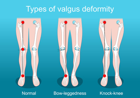 valgus deformities. Knee deformity. healthy joint, knock-knee and bow-leggedness. Human legs, bones and joints. Corrective surgery. Vector poster. Isometric Flat illustration.のイラスト素材