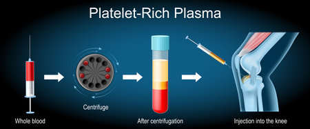 Platelet-rich plasma procedure. Osteoarthritis treatment. Syringe and Human knee joint with inflammation. PRP injection. therapy of joint pain. Regenerative medicine for joint tissue repair and cartilage regeneration. Vector illustrationのイラスト素材