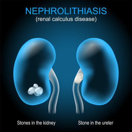 Kidney stone disease. Renal calculus disease. Nephrolithiasis or urolithiasis. Renal calculus that develops in the urinary tract. Vector illustration like X-ray image for healthcare design. Realistic transparent blue kidney with stones and stone in ureter on dark background. Human urinary systemのイラスト素材